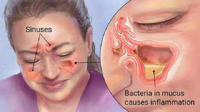 sinusite cirurgia sinusite desvio de septo septoplastia turbinectomia sinusectomia dr luis felipe otorrino alphaville barueri santana de parnaiba cirurgiao